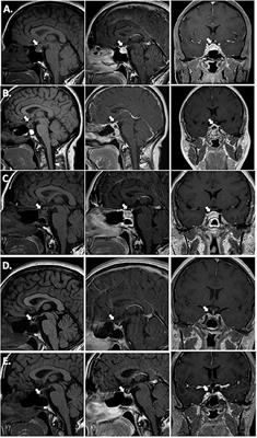 A Remarkable Response of Granulomatous Hypophysitis to Infliximab in a Patient With a Background of Crohn's Disease—A Case Report